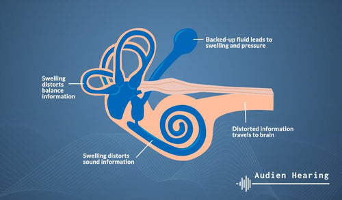 Diagram showing how Meniere's Disease can impact hearing health and cause tinnitus