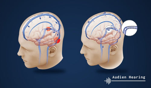 Diagram showing the human brain and ear in relation to surgery for tinnitus